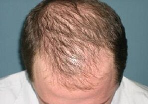 príčiny vypadávania vlasov