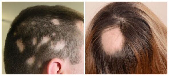 Alopecia areata