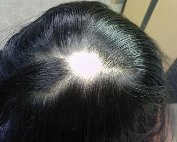 Alopecia areata alebo alopecia areata u žien