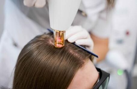 Laserová terapia pre androgénnu alopéciu